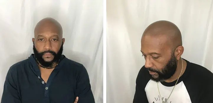Photos showing the before and after results of scalp micropigmentation